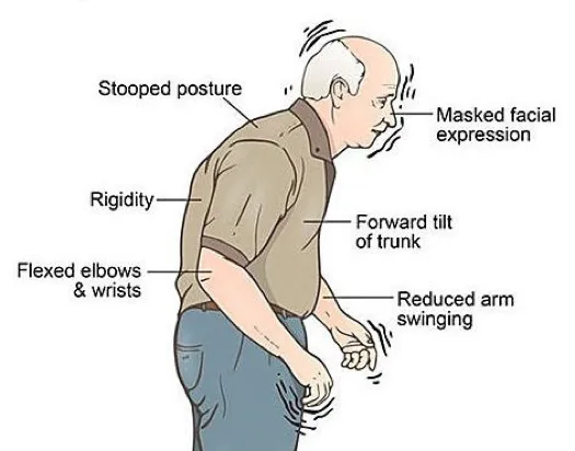 <p>A <strong>progressive neurological disorder</strong> that affects <strong>movement</strong>, causing <strong>tremors, stiffness, and slow movement</strong>.</p>
