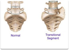 <p>L5 vertebra may fuse with the rest of the sacrum</p>