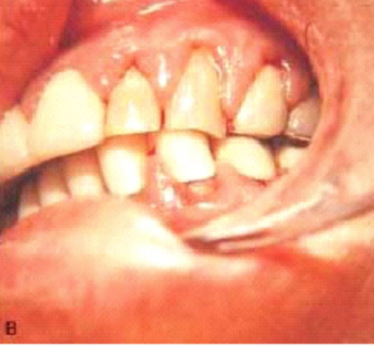<p><br><span>What class of drugs can cause gingival enlargement as seen in the image below?</span></p>