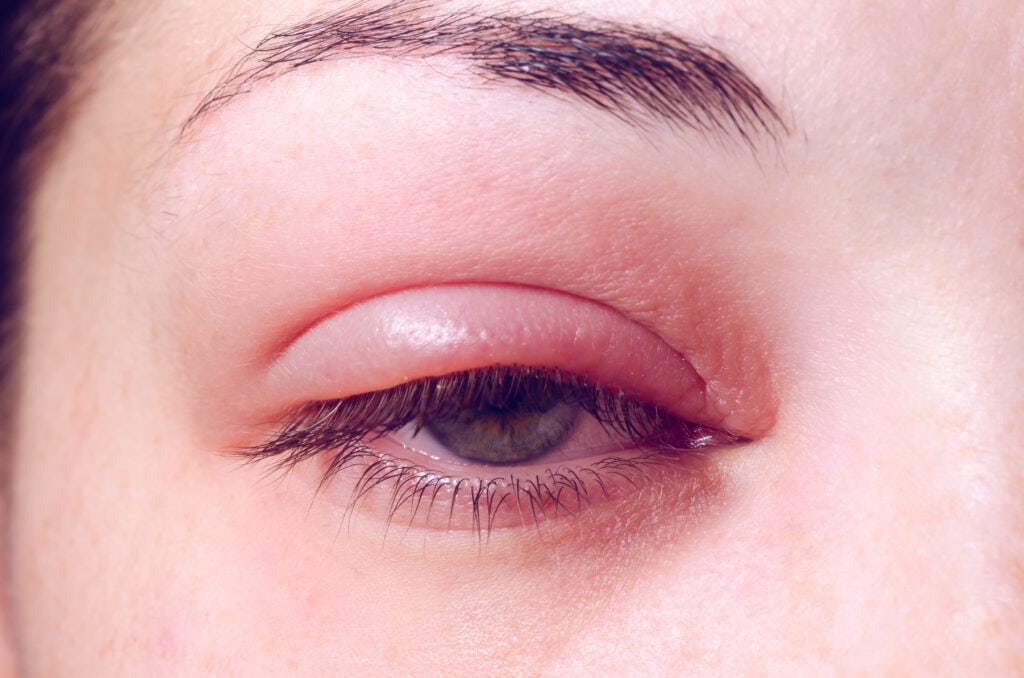 <p>Blepharitis definition*</p>