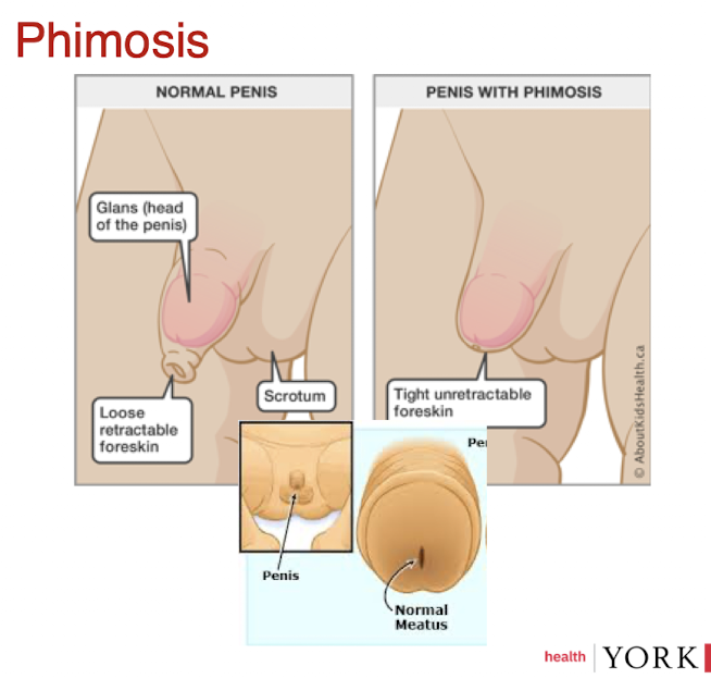 <p>condition in which the <strong>prepuce</strong> (foreskin) is too tight to be retracted over the glans penis.</p>