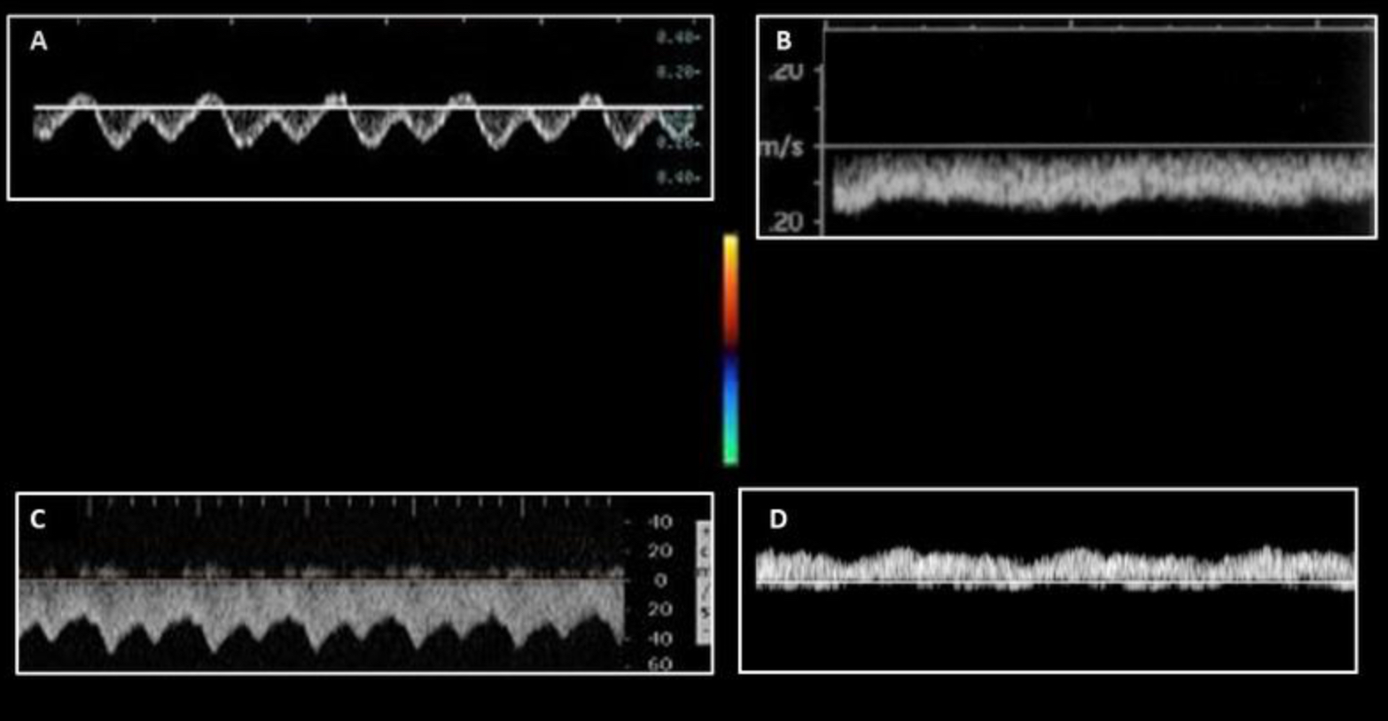 <p>Which waveform represents a normal inferior vena cava waveform?</p>
