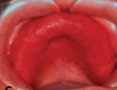 <p>what is this condition</p>