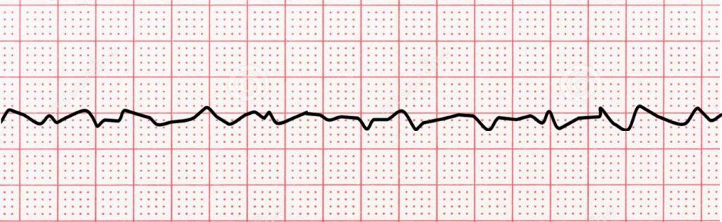 <p>what dysrhythmia is this</p>