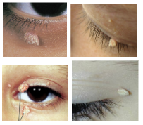 <p>What is the most likely diagnosis ?</p>