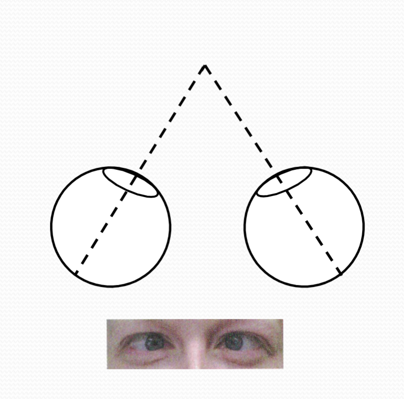 <p>when the sightlines of your eyes converge to look at something closer to you</p>