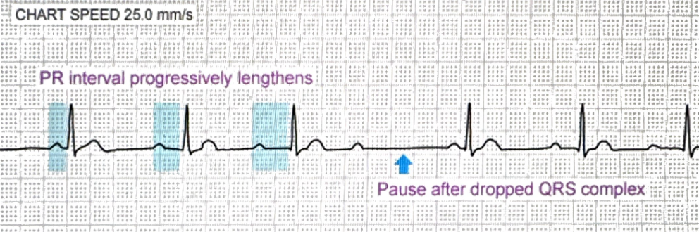 <p>PR gets longer, longer, longer, then QRS drops</p>