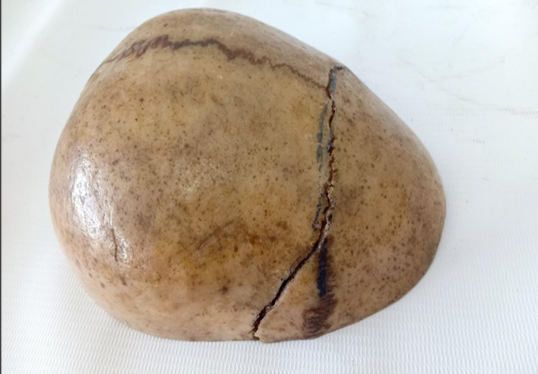 <p>Questions</p><ol><li><p>What is the specimen being examined?</p></li><li><p>What are the types and descriptive features of the fracture?</p></li><li><p>What type of causative instrument and force mechanics produce this injury?</p></li><li><p>How is the time of death estimated?</p></li><li><p>What are the possible causes of death?</p></li><li><p>What is the final diagnosis for this specimen?</p></li></ol><div data-type="horizontalRule"><hr></div><p></p>
