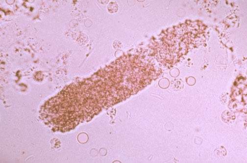 <p>They can be non-pathological (following strenuous exercise) or pathological, indicating significant renal disease like acute tubular necrosis or glomerulonephritis.</p>