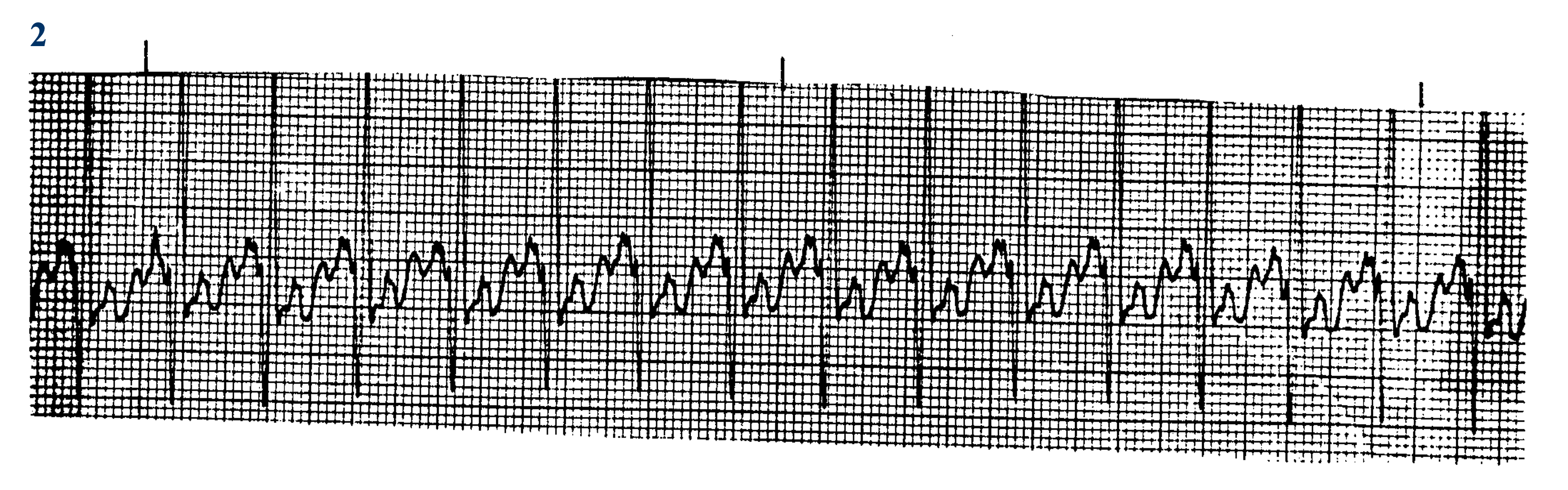 <p>What ECG is this? </p>