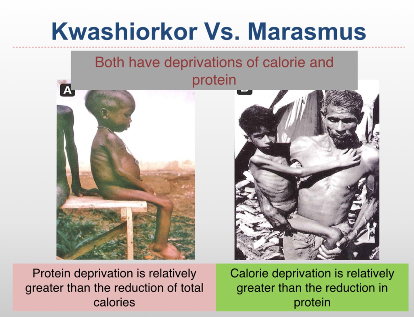 <p>Marasmus is total nutrient deficiency; kwashiorkor is mainly protein deficiency.</p>
