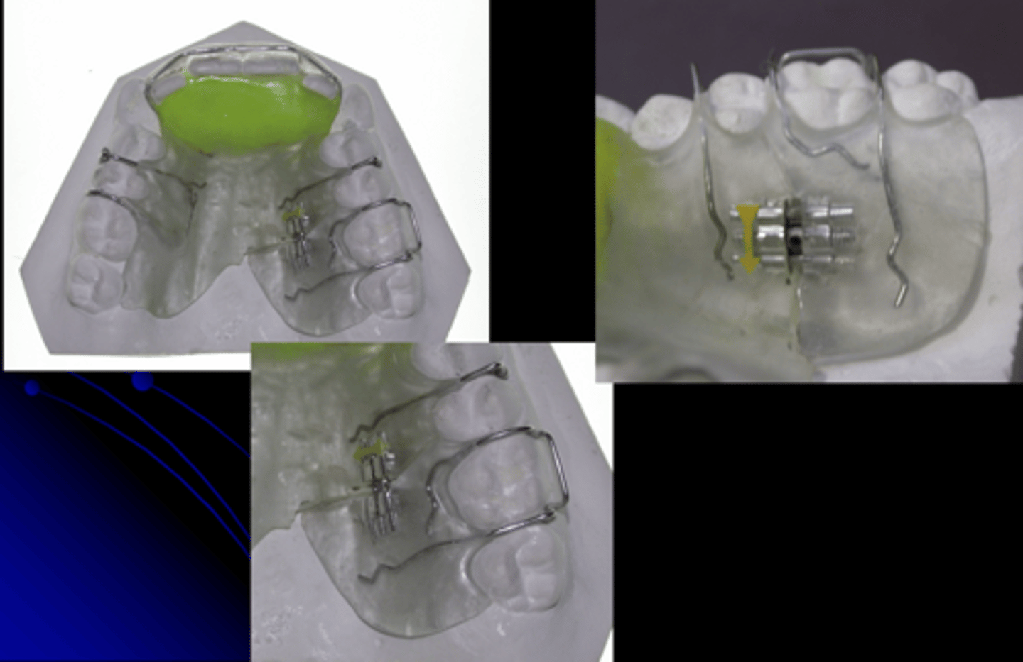 <p>What type of removable appliance are the following?</p>