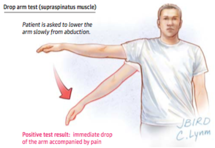 <p><strong>tear of supraspinatus (rotator cuff)</strong></p><p>have patent sitting</p><p>bring their arm up so looks like trying to fly- palm to ground</p><p>ask them to hold position and let go of arm</p><p>if they can hold up arm have them slowly lower it with control</p><p>positive if: cannot hold arm out to side or cant slowly lower arm to ground</p>