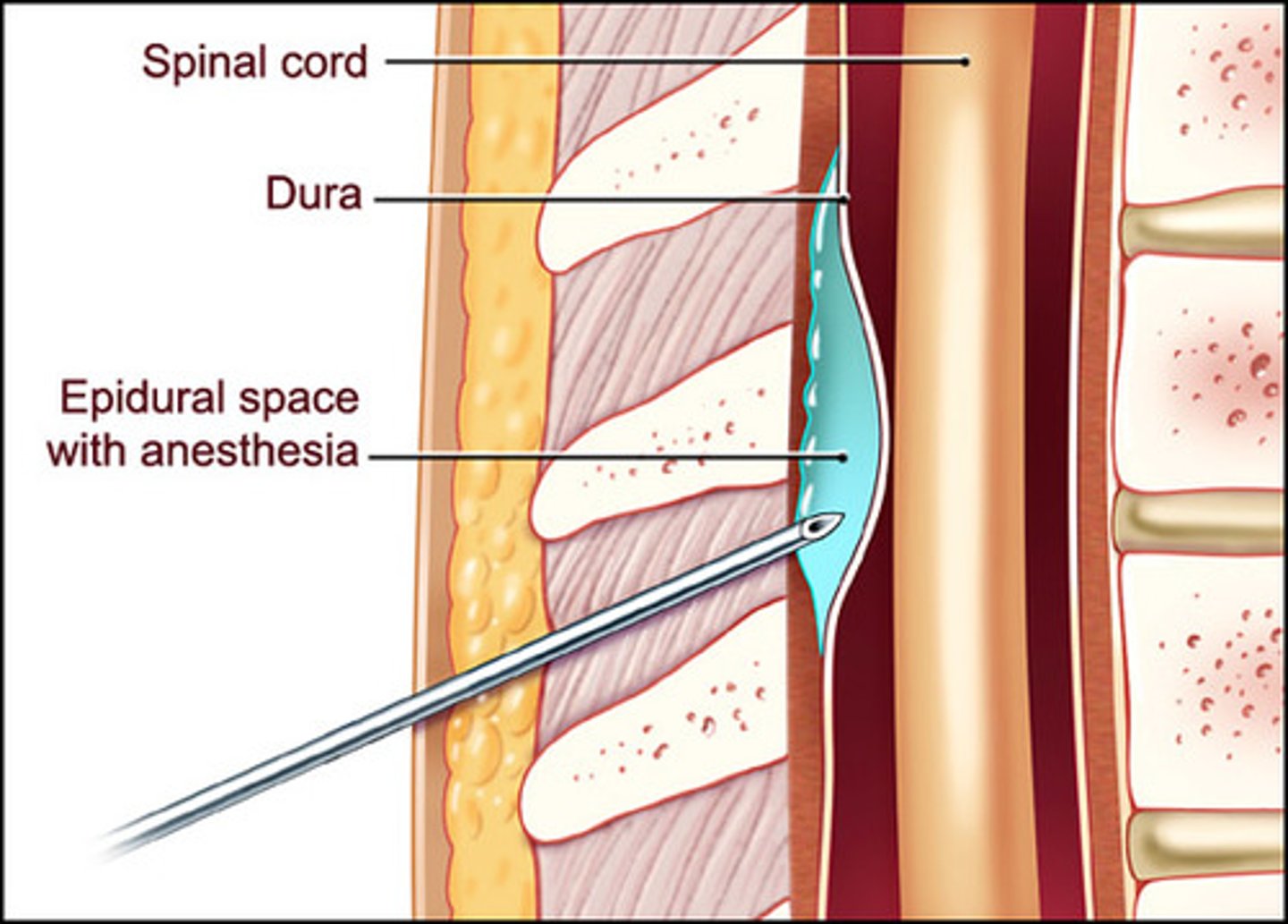 <p>The space between the dural sheath (dura mater) and the vertebral canal.</p>