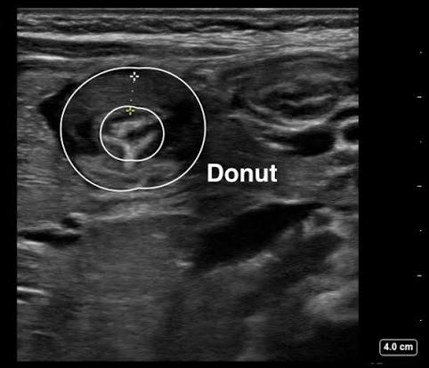 <p>pyloric stenosis</p>