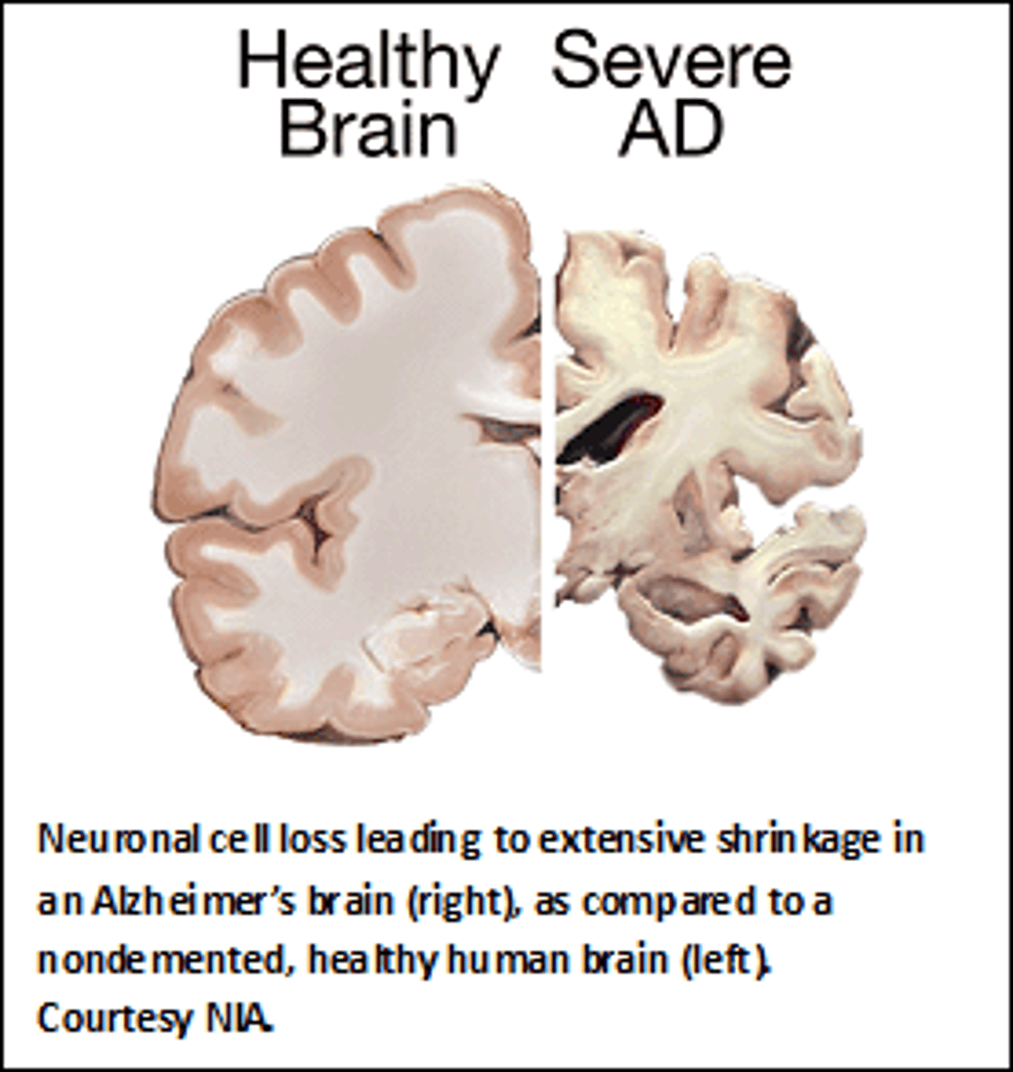 <p>degeneration of neurons in the brain causing progressive memory loss.</p>