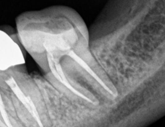 <p>What % of mandibular molars have 1 canal for their distal root?</p>