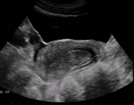 <p>What position is this uterus in?</p><p>a. Anteverted</p><p>b. Retroverted</p><p>c. Anteflexed</p><p>d. Retroflexed</p>