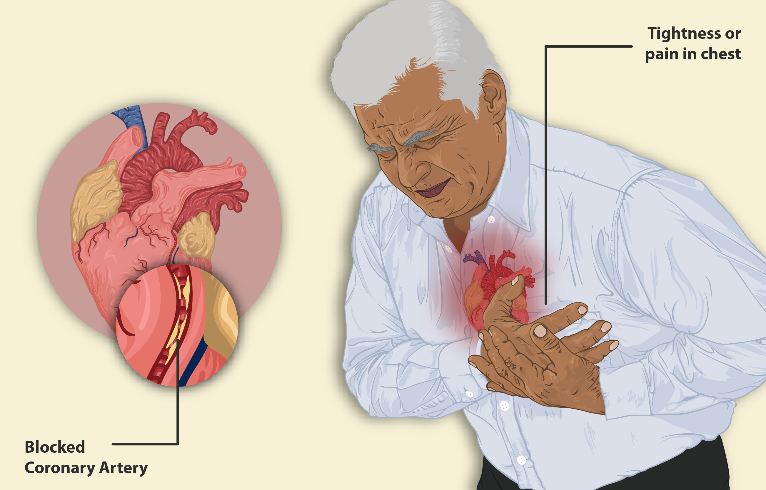 <p><span style="line-height: 23.25px; color: rgb(0, 0, 0);"><strong>Chest pain that occurs when the heart muscle doesn’t get enough <u>oxygen-rich blood</u>, leading t<u>o pressure or fullness in the chest.</u> </strong></span></p>