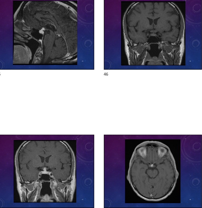 <p>65-year-old male has a past history of CLL and is in remission is currently unwell and has a visual changes</p>