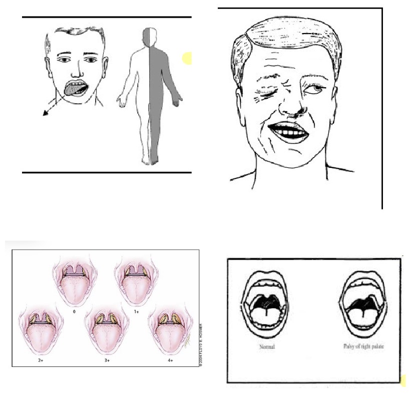 <p><span>• </span><strong><span>Labbra:</span></strong><span> Colore, turgore, tumefazioni, lesioni (herpes, ragadi, sifiloma, carcinomi, angioedema).</span></p><p><span>• </span><strong><span>Cavità orale:</span></strong><span> Si ispeziona con la lampadina. Si ricercano afte (molto dolenti), candidosi (mughetto, placche bianche asportabili, tipiche post-antibiotico/immunodeficienza), macchie pigmentate (Morbo di Addison), teleangectasie.</span></p><p><span>• </span><strong><span>Gengive e denti:</span></strong><span> Flogosi, sanguinamenti, retrazione. Per i denti: lassità, carie, anomalie di forma/posizione.</span></p><p><span>• </span><strong><span>Volta palatina:</span></strong><span> Forma e colore del palato duro. L'ugola bifida può indicare palatoschisi.</span></p><p><span>• </span><strong><span>Lingua:</span></strong><span> Si valuta colore, umidità, dimensioni (macroglossia).</span></p><p><span>• Liscia: senza papille per Deficit vitaminici (B2, PP, B12, B6) o di ferro.</span></p><p><span>• Ad aspetto peloso: Allungamento papille, scura, tipica post-terapia antibiotica.</span></p><p><span>• Scrotale (fissurata): Rischio infezioni per residui di cibo.</span></p><p><span>• A carta geografica: con chiazze rosse per Glossite benigna migratoria.</span></p><p><span>• Leucoplachia: Lesione precancerosa (macchie bianche tipo vernice secca). Sedi frequenti di carcinomi: base, margini, superficie inferiore.</span></p><p><span>• Funzionalità (Nervo Ipoglosso XII): Se paralizzato, la lingua protrusa devia verso il lato della lesione (accompagnata da atrofia e fascicolazioni).</span></p><p><span>• </span><strong><span>Bocca e Nervo Facciale (VII):</span></strong><span> Si valuta la rima buccale e si fa strizzare occhi/digrignare i denti.</span></p><p><span>• Paralisi periferica (Bell): Colpisce l'</span><strong><span>intero emivolto</span></strong><span>. Mancato corrugamento della fronte, lagoftalmo (occhio non si chiude), fenomeno di Bell (occhio devia in alto), rima orale obliqua.</span></p><p><span>• Paralisi centrale: Colpisce solo la parte </span><strong><span>inferiore</span></strong><span> del volto (fronte e chiusura occhio intatte).</span></p><p><span>• </span><strong><span>Faringe e Tonsille:</span></strong><span> Segni di infezione (faringotonsillite streptococcica con </span><strong><span>placche essudatizie</span></strong><span>, o difterite con pseudomembrane). Le tonsille possono ipertrofizzarsi causando problemi respiratori.</span></p><p><span>• </span><strong><span>Palato molle (Nervi Glossofaringeo IX e Vago X):</span></strong><span> Si fa dire "Ahh". In caso di paralisi, il palato sale asimmetricamente e l'ugola devia verso il lato sano.</span></p>