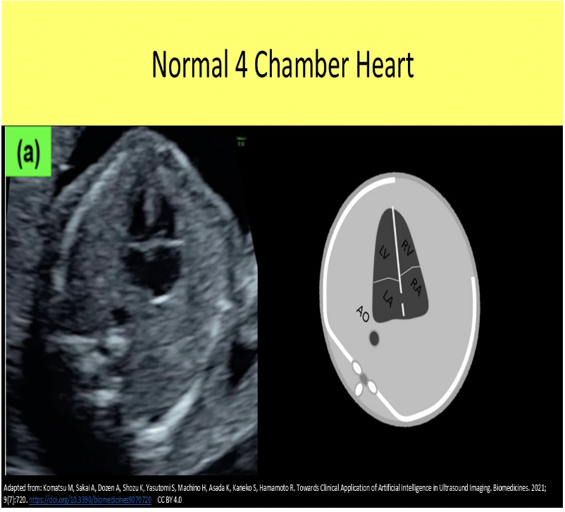 <p>C. A single rib in profile on both sides the of the chest</p>