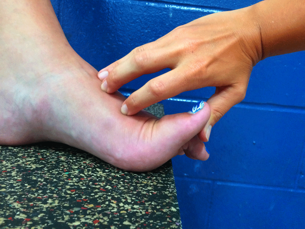 <p></p><p>A physical therapist examines the foot of a patient diagnosed with plantar fasciitis by performing the Windlass test. What would be the expected response for this test given the patient’s diagnosis?</p><p> <strong>1. </strong>Pain elicited at the base of the great toe</p><p><strong> 2. </strong>Pain elicited at the medial calcaneal tubercle</p><p><strong> 3. </strong>Flattening of the medial longitudinal arch</p><p><strong> 4. </strong>Increased height of the medial longitudinal arch</p>