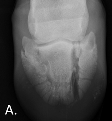 <p>Which fracture type is this?</p>