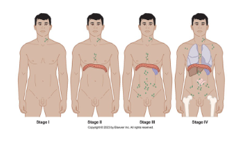 <p>• Originate in BM &amp; lymph</p><p>• Large, painless lymph node(s)</p><p>• Fevers, night sweats, unplanned weight loss</p><p>• Some have no symptoms at time of diagnosis</p><p><strong>Malignant Lymphomas Take Action: Interventions</strong></p><p><strong>• Early stage with favorable prognostic features: </strong>short duration of ABVD chemotherapy (usually two cycles including doxorubicin, bleomycin, vinblastine, and dacarbazine) followed by restricted involved-field radiation therapy (IFRT)</p><p><strong>• Limited stage with unfavorable features:</strong> longer course of ABVD chemo (4-6 cycles) then, higher dose of IFRT</p><p><strong>• Advanced stage: </strong>ABVD chemo without radiation</p><p></p>