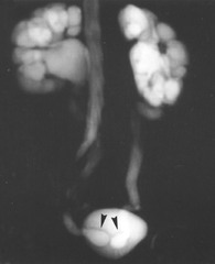 <p>Cystic dilation of the distal ureter within the bladder wall (often associated with duplicated collecting systems)</p>