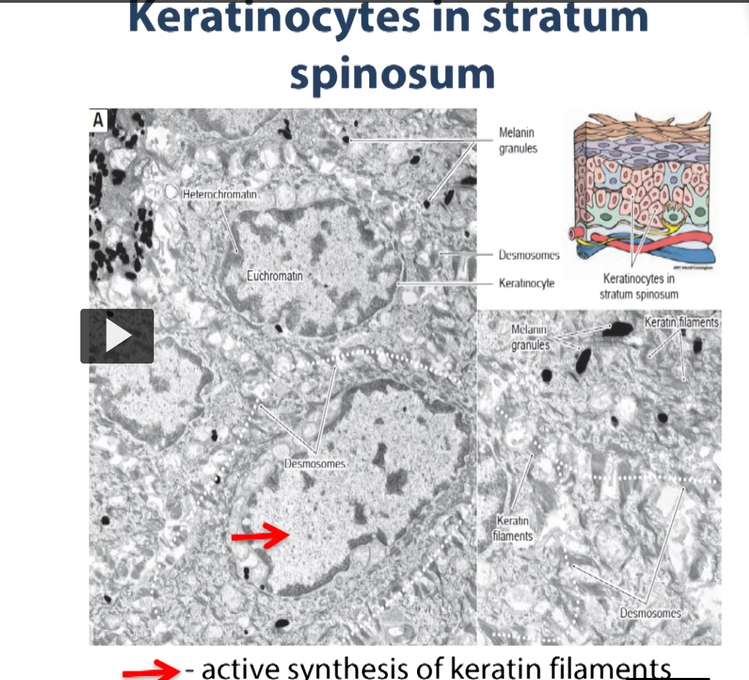 <p><u>Keratinocytes in stratum spinosum </u></p><p>Here we have an electron micrograph illustrating various aspects of the stratum spinosum. That layer above the basalis, which has all cytoplasmic processes, which you can see here. So these are the extensions, dendrites. These are the smallest spinous extensions of the cell body, that contact other similar extensions from adjacent cells. Notice that the chromatin inside the nucleus of the cells is euchromatic for the most part. What that means is these cells are active in protein synthesis (keratin protein synthesis). </p><p>There is a higher magnification insert on the bottom right so you are able to see the spiny extensions from the cells, giving the layer of these cells stratum “spinosum”. </p>