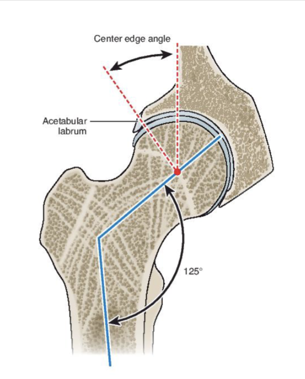 <p><span><strong>Depth:</strong> Center edge angle → Determines femoral head coverage</span></p><ul><li><p><span><strong>Dysplasia</strong></span></p><ul><li><p><span><strong>Low </strong>coverage → shallow acetabulum/socket → <strong>High </strong>mob + <strong>Low </strong>stability </span></p></li></ul></li></ul><ul><li><p><span><strong>Coxa profunda</strong></span></p><ul><li><p><span><strong>High </strong>coverage → too deep/overcovered → <strong>Low</strong> mob + <strong>High</strong> stab</span></p></li></ul></li></ul><p></p>