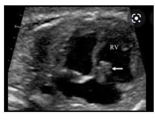 <p>Arises from the endocardium • </p><p>Most frequently in left atrium (75%) and right atrium (25%) • </p><p>Attached to the fossa ovalis by a pedicle</p>