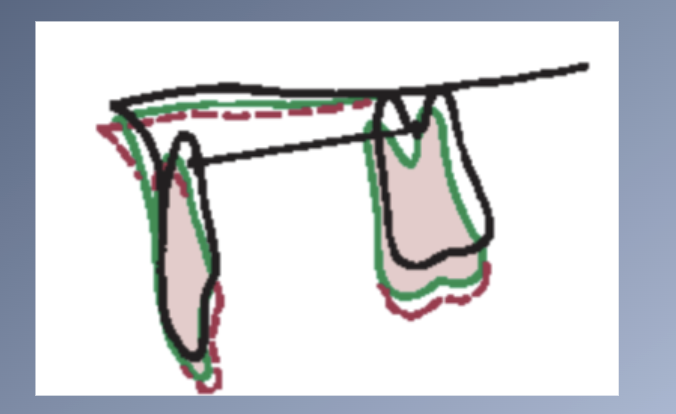 <p><span>ERUPTION PATH OF MAXILLARY TEETH is normally down and slightly forward.</span><br><span>- Normal growth: Mx rotates forward à tip the incisors forward</span><br><span>- Mx frequently rotates backward → Directs the anterior teeth more posteriorly → upright incisors and decrease their prominence.</span></p><p><span>4. Movement of teeth relative to the cranial base</span><br><span>- Translocation: Teeth moved along with the jaw in which they are embedded (50%)</span><br><span>- True eruption: Movement of the tooth within its jaw (50%)</span></p>