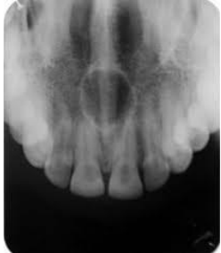 <p>62 year old male patient with complaint of swelling in midline of palate. Provide differential diagnosis and justify</p>