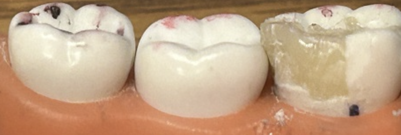 <p>How would you correct this restoration?</p>