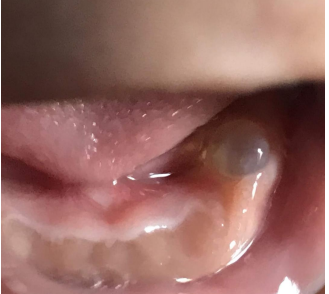 <p>The mother of a 1 month old baby has a concern of a bubble in the mouth of her kid. The clinical image is shown below. There is no pain or any other symptoms. Provide diagnosis and synonym</p>