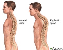 <p>excessive outward curvature of the upper thoracic spine, causing hunching of the back.</p>