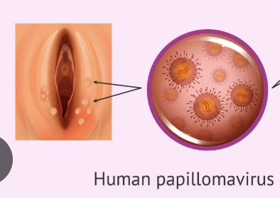 <p>HPV</p>