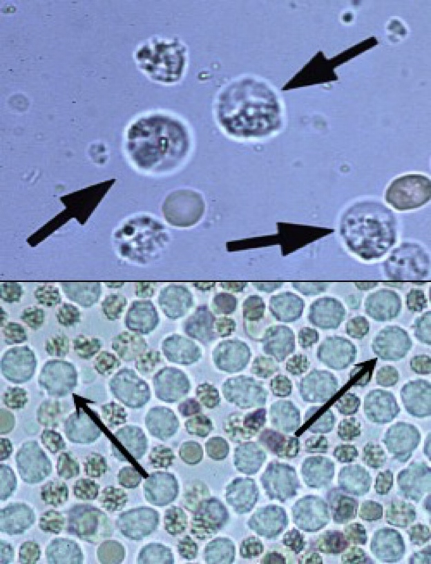 <ul><li><p>Spherical in shape, can appear dull gray or greenish-yellow in color. </p></li><li><p>ID’d by characteristic granules or lobulations of the nucleus.</p></li><li><p>In concentrated urine, they shrink.</p></li><li><p>In diluted urine, they swell.</p></li></ul><p></p>