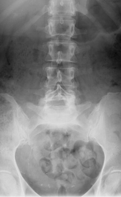 <p>What is the sign/finding and what is the diagnosis?</p>