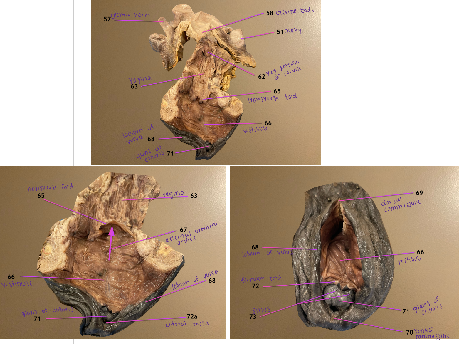 <ol start="62"><li><p>vaginal portion of cervix</p></li><li><p>vagina</p></li></ol><ol start="65"><li><p>transverse fold: landmark separating 63 &amp; 66</p></li><li><p>vestibule</p></li></ol><p></p>