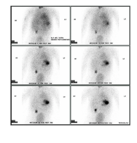 <ul><li><p>focal area with increased uptake</p></li><li><p><strong>normally in RLQ</strong></p></li><li><p><strong>seen within 5-10 min. of injection</strong></p></li><li><p>continuous incr. intensity with imaging </p></li></ul><p></p>