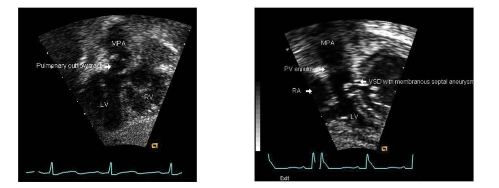 <p>It may be caused by:</p><p>Caused by a fibrous ridge or aneurysm from the excessive membranous tissue (subpulmonary)</p><p><strong>membranous septum</strong>, which is the thin/fibrous part of the septum near the AV valves and outflow area.</p><p>The word <strong>“subpulmonary”</strong> just tells you <strong>where it is located</strong>:</p><p><strong>subpulmonary = under the pulmonary valve / under the pulmonary outflow tract</strong></p><p>So the slide means:</p><p><strong>Extra fibrous membranous septal tissue</strong><br>→ forms a ridge or bulges like an aneurysm<br>→ sits <strong>under the pulmonary valve</strong><br>→ can narrow/block flow going to the pulmonary artery/lungs.</p>