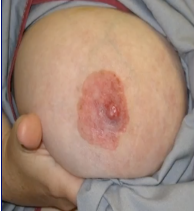 <p>What type of DCIS?</p>