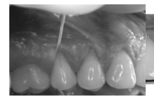 <p>a space or opening made by or as if by splitting : fissure or a V-shaped indented formation</p><ul><li><p>usually caused by aggressive flossing</p></li></ul><p></p>