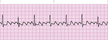 <p>Atrial Flutter</p>