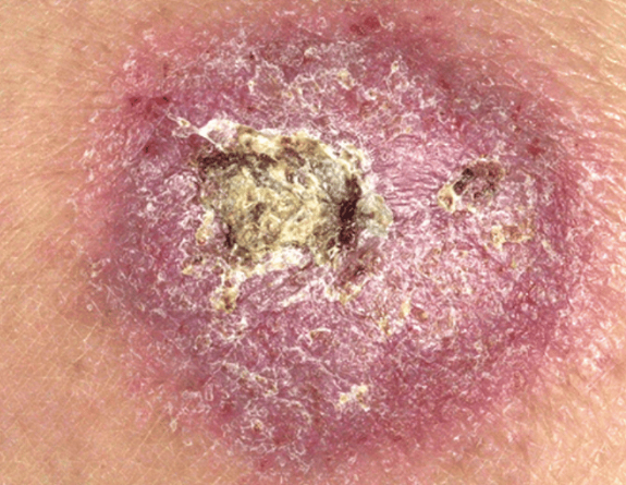 <p>Crusting</p>