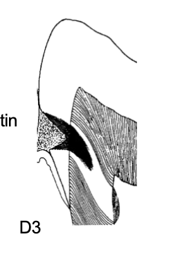<p>D3</p><ul><li><p>kariesangrepp med betydlig spridning i dentin. </p></li></ul><p></p>