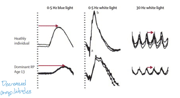 <ul><li><p>Reduced scotopic (rod) ERG amplitudes (measured with blue light)</p></li><li><p>Prolonged scotopic implicit times<br>These reflect primary rod photoreceptor degeneration, characteristic of early RP.</p></li></ul><p></p>